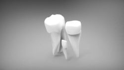 Types of dental implants