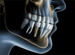 animation view of dental implant.