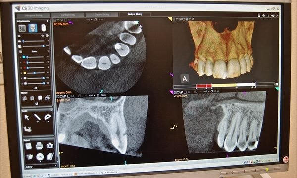 Graph view of Detnal implant