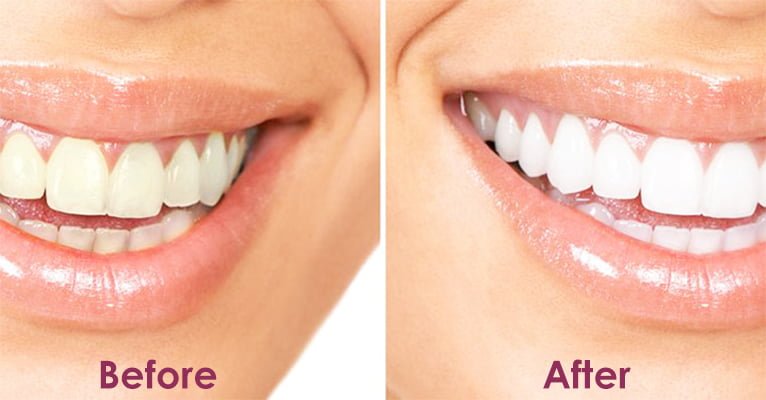 before and after teeth cleaning