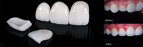 ceramic veneers smile makeover.