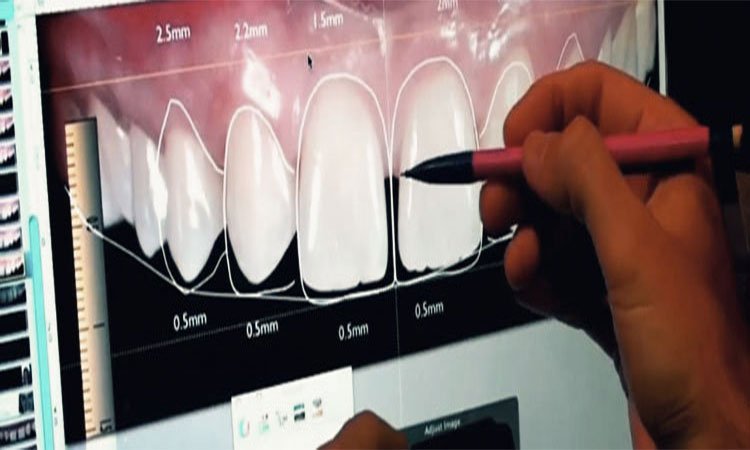 Demonstrating digital smile designing