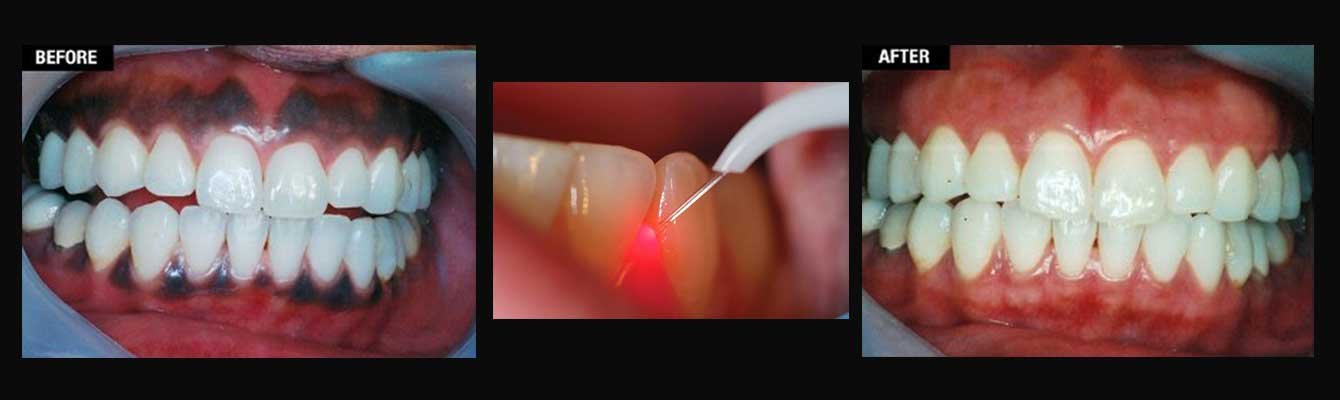 laser gum treatment