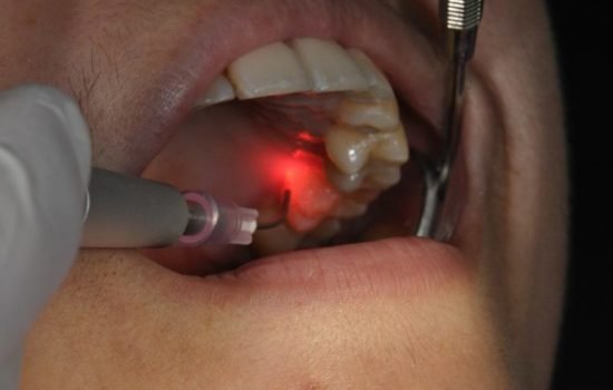 laser gum treatment