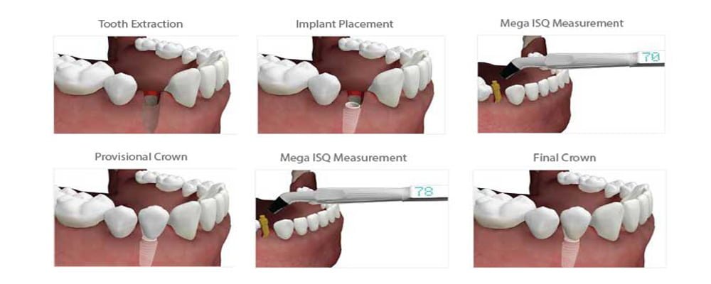 Osstell treatment process