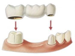 crowns and bridges treatment