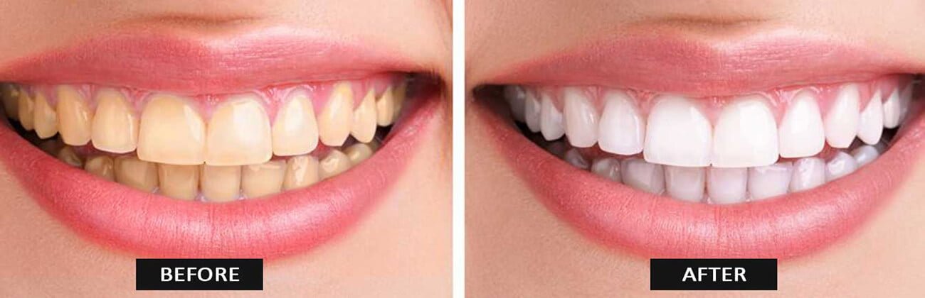 before after laser teeth whitening Punyam dental.