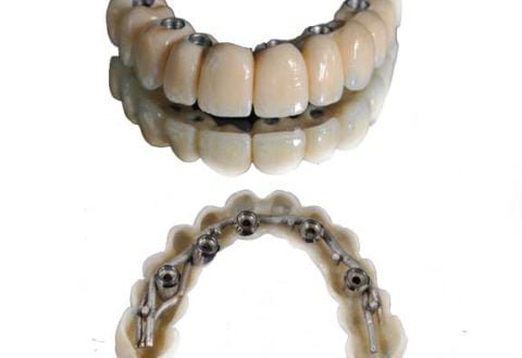 WeldOne treatment on teeth